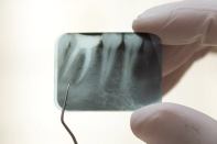 Bioteeth may soon be grown in human jaws from gum tissue.